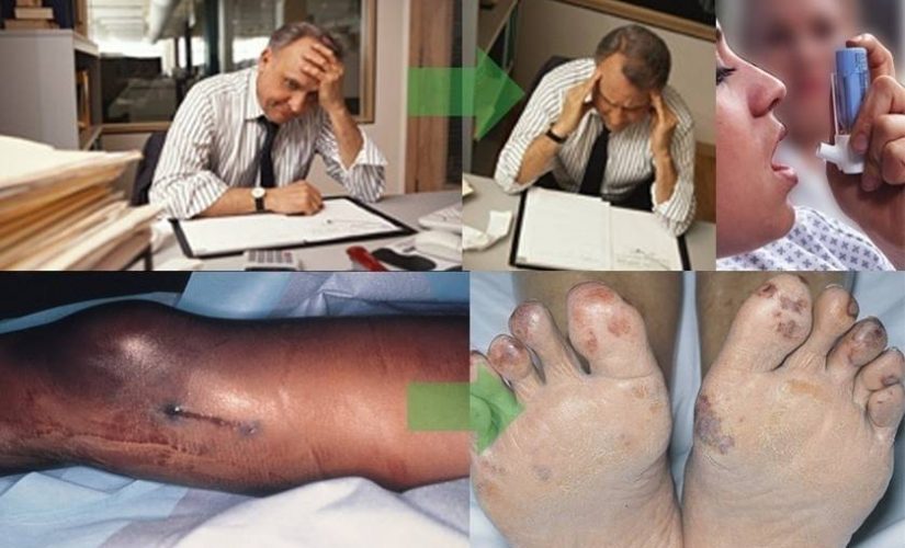 TERAPI OZON UNTUK DIABETES